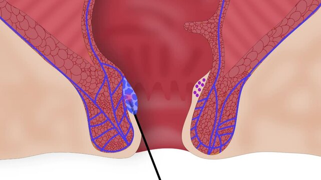 Laser coagulation of the hemorrhoid node
