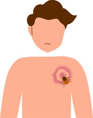 Fototapeta premium Lyme disease Illustration 