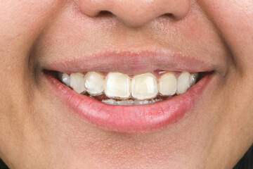 close up of a mouth with clear aligner