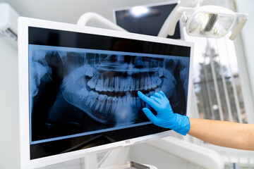 Dentist reviewing dental x-ray on computer screen. A dentist inspects a dental x-ray displaying...