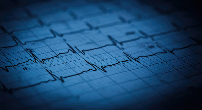 EKG arrhythmia absoluta, printout background