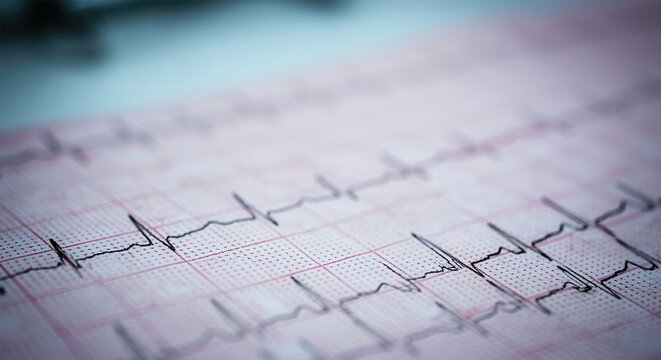EKG arrhythmia absoluta, printout background