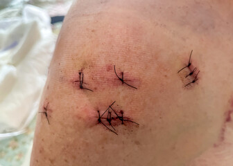 Stitches After Shoulder Rotator Cuff Surgery