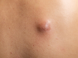 Skin Bump on Human Body Showing the Texture and Color of the Surface Under Natural Light Conditions