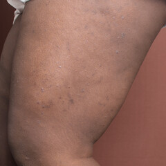 Eczema on brown skin, atopic dermatitis and prurigo nodularis on brown skin leg, eczema breakout on...