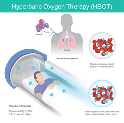Hyperbaric Oxygen Therapy. A man has recumbent in tunnel glass for hyperbaric oxygen therapy pass by respiratory into blood vessel.