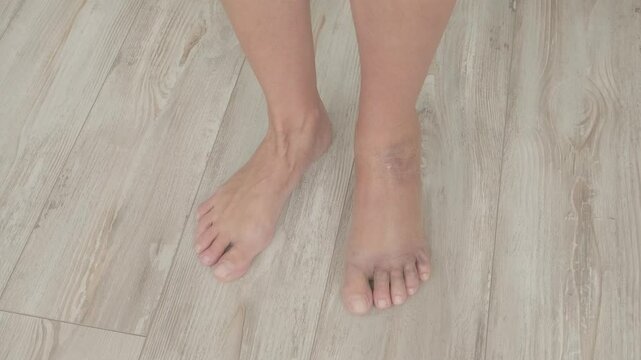 womans injured foot with hematomas, panorama close-up, slow motion
