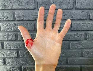Bleeding wound on the thumb finger of the left hand. The man was injured by negligence at work. A...