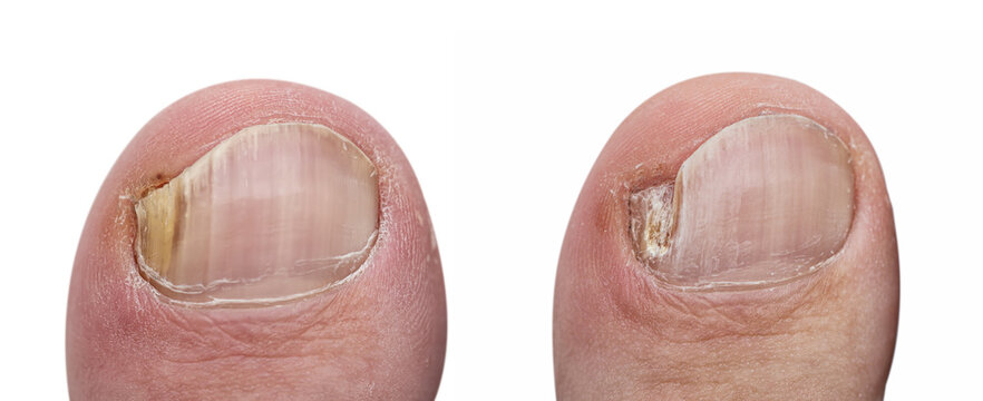 Toenail fungus close up with a treated nail by a podologist isolated on white background. Before and after treatment. Nail fungus infection macro