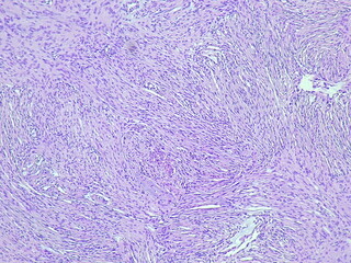 Photomicrograph of meningothelial meningioma soft tissue tumor in anatomical pathology laboratory