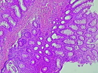 Ulcerative colitis photomicrograph in anatomical pathology laboratory