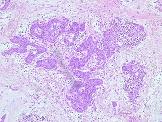 Photomicrograph pleomorphic adenoma in submandibular region tumor in anatomical pathology laboratory
