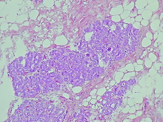 Human breast cell tissue under a microscope in a pathology laboratory. Microscopic view of...