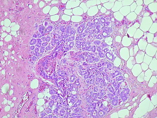 Human breast cell tissue under a microscope in a pathology laboratory. Microscopic view of...