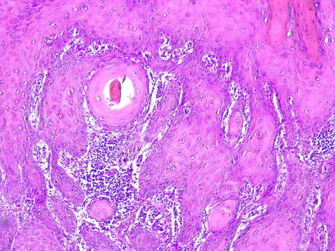 Photomicrograph of chronic osteomyelitis under a microscope in a pathology laboratory