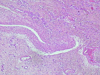 Photomicrograph Benign giant cell tumor (GCT) in the right leg area in the anatomical pathology...
