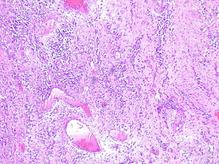 Photomicrograph Benign giant cell tumor (GCT) in the right leg area in the anatomical pathology...