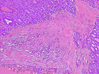 Photomicrograph showing histology of benign thyroid nodule under microscope with struma colloids...