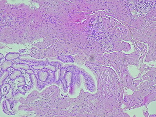 Human cell tissue under microscope in pathology laboratory. Microscopic picture of chronic gastric...