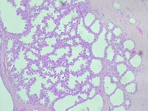 photomicrograph Histology of a breast biopsy from a pregnant woman showed a lactating adenoma under microscope in pathology anatomy laboratory