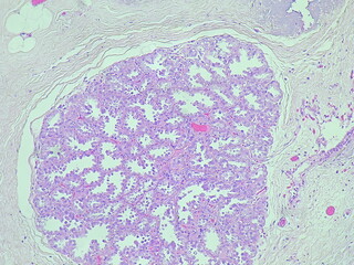 photomicrograph Histology of a breast biopsy from a pregnant woman showed a lactating adenoma under...