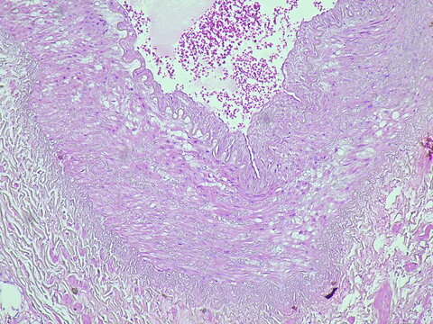 Photomicrograph of pyonephrosis + angiomyolipoma in a patient diagnosed with pyonephrosis sinistra in the anatomical pathology laboratory