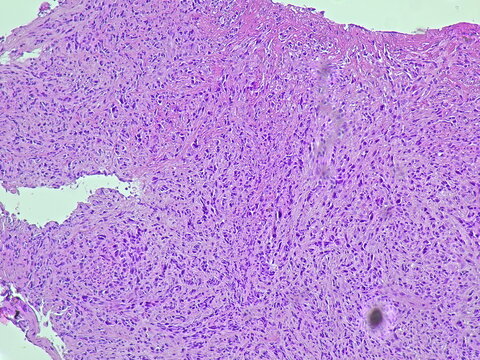 Photomicrograph of adenocarcinoma with patient diagnosis of hematemesis in anatomical pathology laboratory