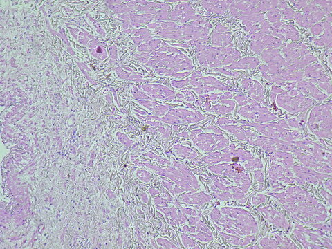 Photomicrograph of pyonephrosis + angiomyolipoma in a patient diagnosed with pyonephrosis sinistra in the anatomical pathology laboratory
