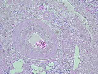 Photomicrograph of pyonephrosis + angiomyolipoma in a patient diagnosed with pyonephrosis sinistra in the anatomical pathology laboratory