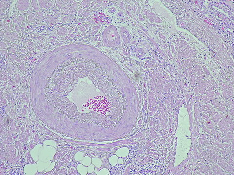 Photomicrograph of pyonephrosis + angiomyolipoma in a patient diagnosed with pyonephrosis sinistra in the anatomical pathology laboratory