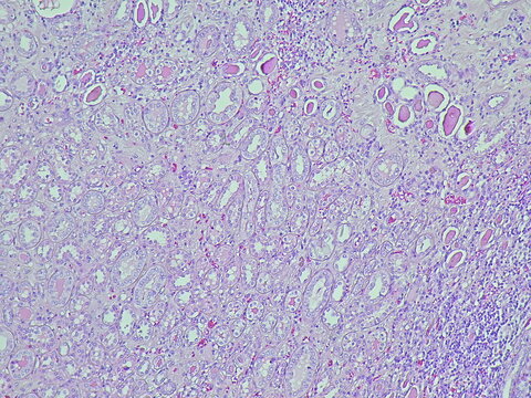 Photomicrograph of pyonephrosis + angiomyolipoma in a patient diagnosed with pyonephrosis sinistra in the anatomical pathology laboratory