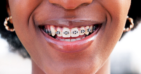 Happy, smile and mouth of woman with braces in city with confidence, pride and joy outdoors for...