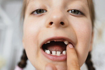 Close-up portrait of Caucasian girl with braided hair showing her missing baby teeth. Young child experiencing natural tooth loss in cozy home setting.