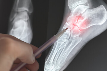 Doctor learning X-ray of foot fingers. Radiography foot bones. Metatarsal, Tarsals, Phalanges bone. Treatment of Sprains and dislocations of the muscles and bones of the foot.