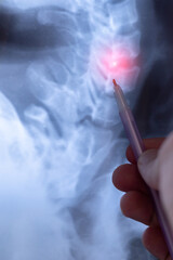 Vertical image of X-rays for Diagnosing Whiplash Injuries of Cervical spine..Trauma of Axial skeleton.