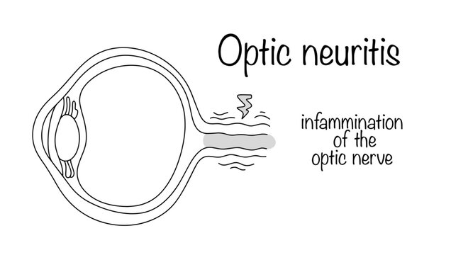 Optic neuritis