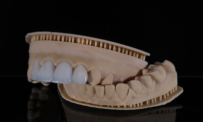 Glass ceramic laminate veneers, known as dental laminates in dental aesthetic dentistry. Dental veneers. E-Max dental crowns. Smile makeover and smile design treatment.  © UniqDream