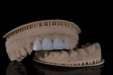 Glass ceramic laminate veneers, known as dental laminates in dental aesthetic dentistry. Dental veneers. E-Max dental crowns. Smile makeover and smile design treatment.  © UniqDream