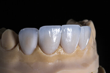 Dental porcelain crowns. Dental laminate veneers in smile design treatment in dentistry. Smile makeover.
