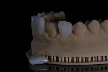 Computer-aided smile design treatment with porcelain crowns in digital dental dentistry. Digital jaw model with laminate veneers for dental smile design. Smile makeover. © UniqDream