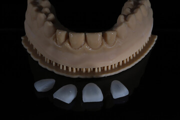 Computer-aided smile design treatment with porcelain crowns in digital dental dentistry. Digital jaw model with laminate veneers for dental smile design. Smile makeover. © UniqDream