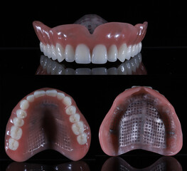 Dental treatment applied for edentulous individuals in dentistry. Dental jaw total prosthesis. Smile makeover.  © UniqDream