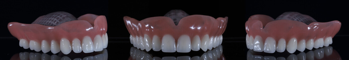 Dental treatment applied for edentulous individuals in dentistry. Dental jaw total prosthesis. Smile makeover.  © UniqDream