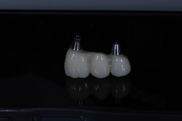 In dental and cosmetic dentistry, bone-anchored dental implant treatment with porcelain bridge prostheses and implant screws.  © UniqDream