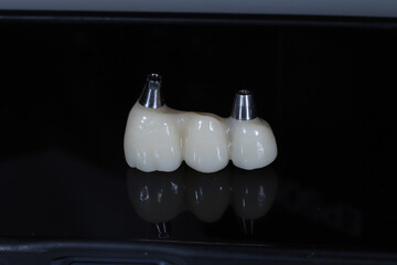 In dental and cosmetic dentistry, bone-anchored dental implant treatment with porcelain bridge prostheses and implant screws.  © UniqDream