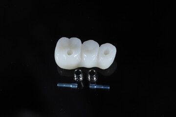 In dental and cosmetic dentistry, bone-anchored dental implant treatment with porcelain bridge prostheses and implant screws.  © UniqDream