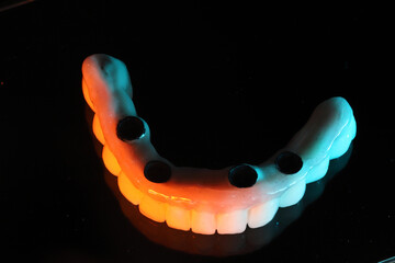 In dental and cosmetic dentistry, bone-anchored dental implant treatment with porcelain bridge prostheses and implant screws.  © UniqDream