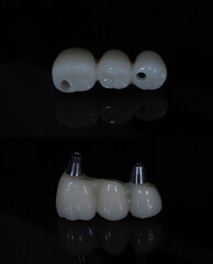 In dental and cosmetic dentistry, bone-anchored dental implant treatment with porcelain bridge prostheses and implant screws.  © UniqDream