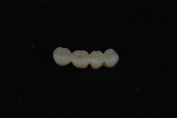E-max or zirconia glass ceramic porcelain bridge crown treatment and implant-supported crown treatment used in dental dentistry for cases of tooth loss. Smile design. © UniqDream