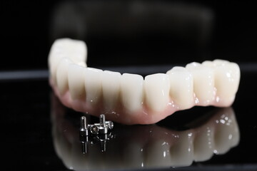 The All-on-4, All-on-X, and All-on-4 treatment concepts in dental implant therapy provide full arch dental prosthesis for completely edentulous jaws. Dental implants are a dentistry treatment placed  © UniqDream